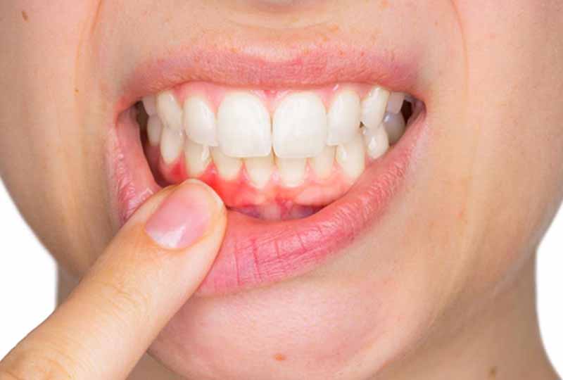Viêm nha chu là bệnh lý răng miệng phổ biến ai cũng có thể mắc phải
