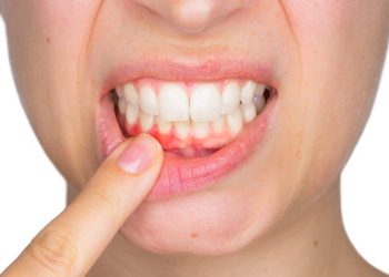 Viêm nướu răng gây ra nhiều ảnh hưởng đến sức khỏe