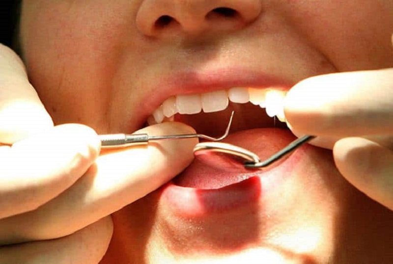 Trám răng giúp giảm ê buốt và giúp loại bỏ vi khuẩn gây bệnh răng miệng