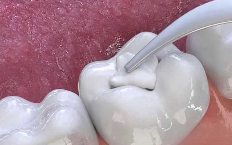 Đa số các bệnh nhân đều nhận định: Trám răng sâu không gây quá nhiều đau đớn