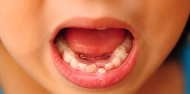 Trẻ mọc răng quá muộn có thể dẫn tới răng sữa và răng vĩnh viễn mọc cùng lúc