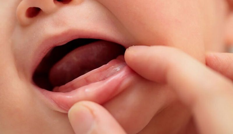 Trẻ 10 tháng chậm mọc răng khiến nhiều bậc phụ huy lo lắng