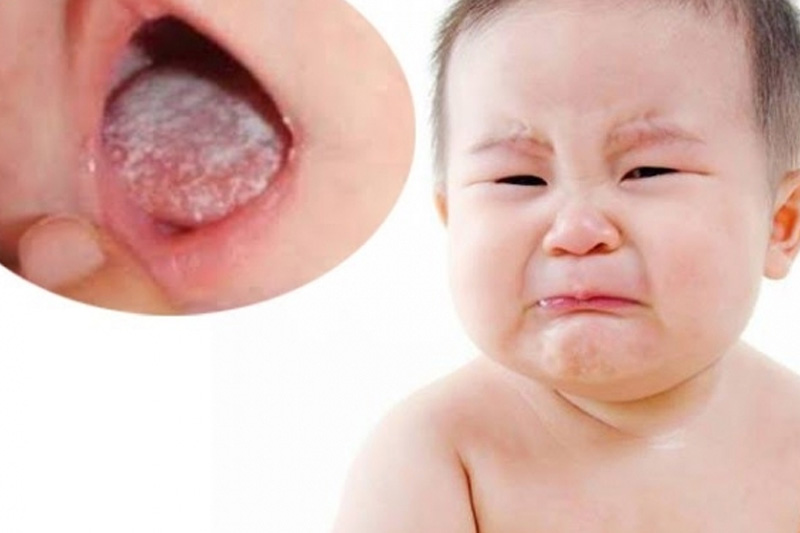 Tưa lưỡi mọc dài, lan rộng khiến trẻ đau, khó nuốt, bỏ bú và quấy khóc