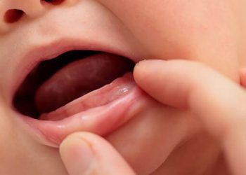Vì sao trẻ chậm mọc răng? Cách xử trí tốt nhất