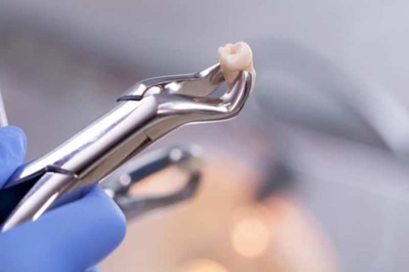 Giải pháp cuối cùng của việc xử lý viêm lợi trùm chính là nhổ răng khôn