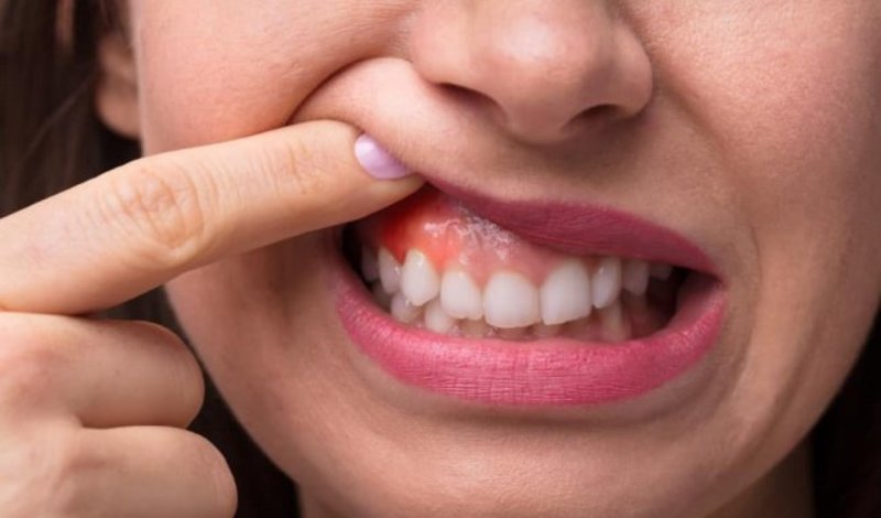 riệu chứng dễ nhận biết của viêm nha chu cấp là nướu răng từ màu hồng đậm chuyển sang màu đỏ sẫm
