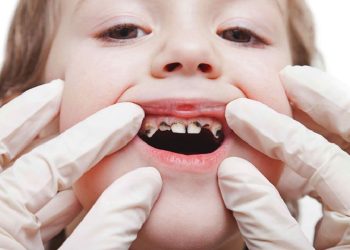 Bé 2 tuổi bị sâu răng, nguyên nhân và cách xử lý hiệu quả