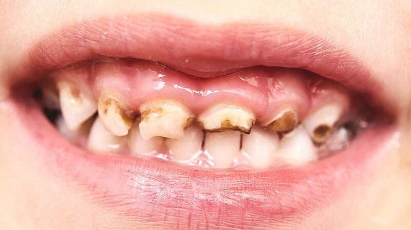 Sâu răng còn làm ảnh hưởng đến sức khỏe răng miệng