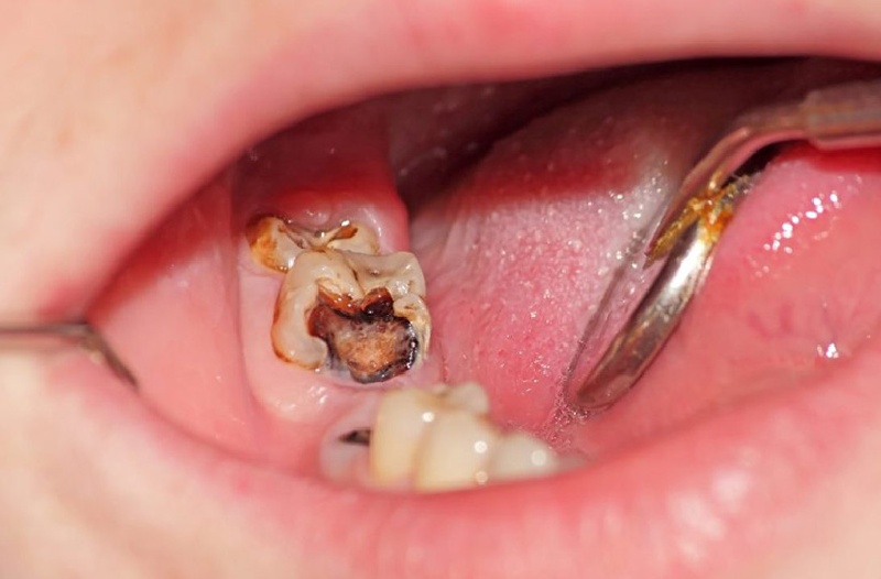 Sâu răng có dẫn đến ung thư hay không?