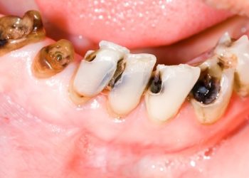 Cảnh báo: Sâu răng dẫn đến ung thư, bạn không nên lơ là