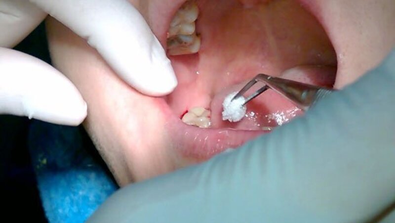 Nhổ bỏ răng khôn là phương pháp được bác sĩ khuyến khích thực hiện