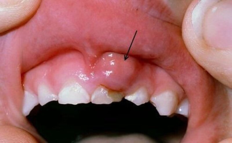 Bệnh viêm nướu răng chính là sự tấn công của những vi khuẩn