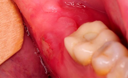 Viêm lợi trùm răng khôn uống thuốc gì