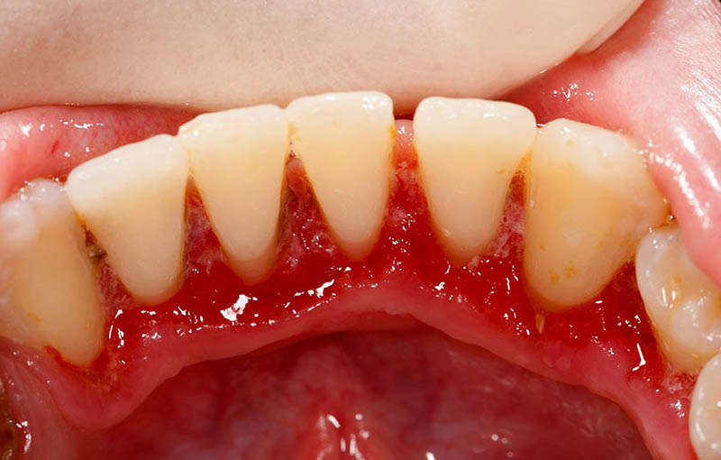 Viêm nướu răng nên ăn gì là thắc mắc của nhiều người bệnh