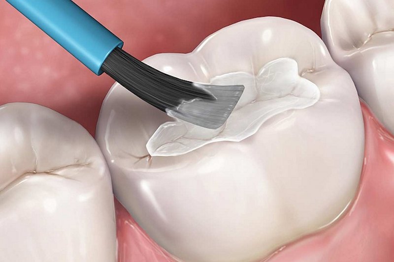Hàm trám răng là biện pháp thường được bác sĩ chỉ định để bảo vệ chân răng