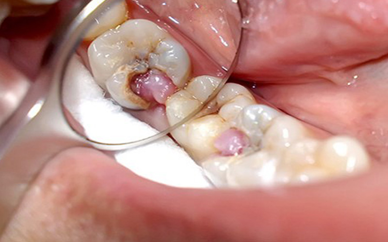 Tình trạng viêm tủy răng sẽ gây ra những cơn đau buốt dữ dội