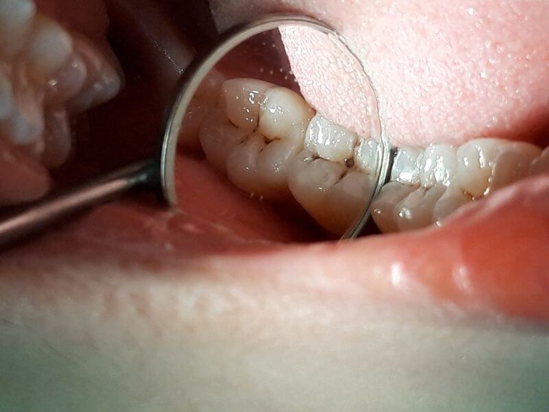 Vôi răng lâu ngày có thể dẫn đến sâu răng