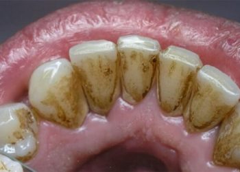 Cao răng là gì? Tác hại, cách loại bỏ và biện pháp phòng ngừa hiệu quả nhất