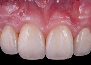 Nướu răng là gì? Vai trò, cấu tạo và các vấn đề thường gặp