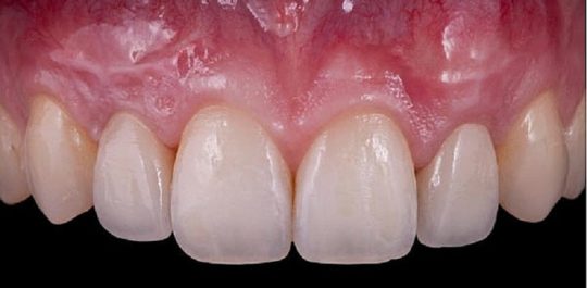Nướu răng là gì? Vai trò, cấu tạo và các vấn đề thường gặp