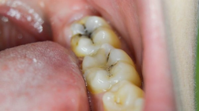 Sâu răng nếu không được xử lý kịp thời sẽ gây ra biến chứng