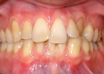 Răng khấp khểnh - Nguyên nhân và những vấn đề thường gặp