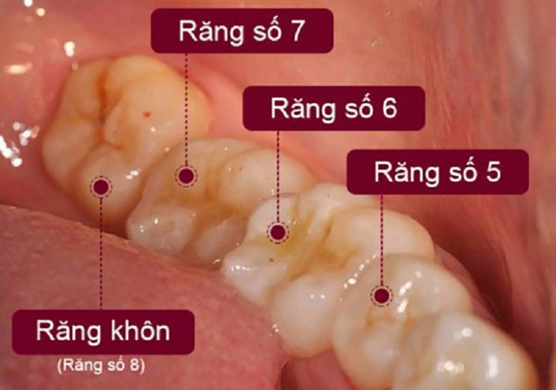 Răng 38 là răng gì - chính là răng khôn hàm dưới bên trái