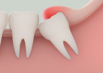 Răng khôn là gì? Chuyên gia giải đáp những vấn đề thường gặp