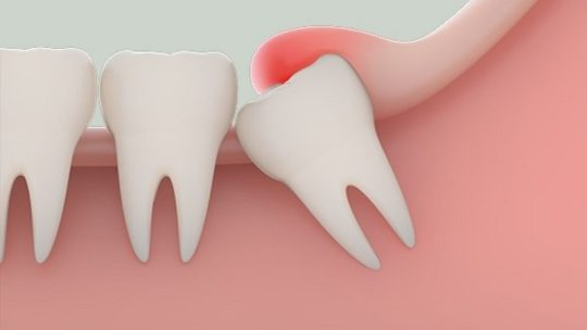 Răng khôn là gì? Chuyên gia giải đáp những vấn đề thường gặp
