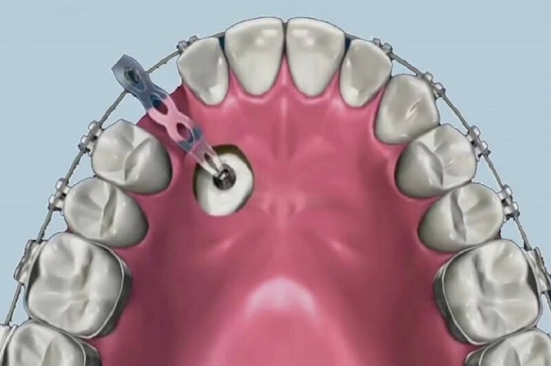 Răng mọc ngầm có thể xuất phát từ việc thiếu chỗ trong cung hàm