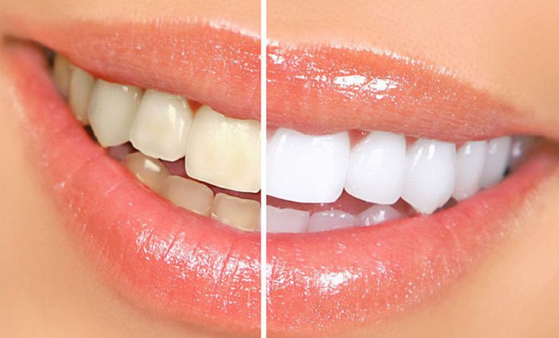 Tẩy trắng răng là phương pháp thẩm mỹ nha khoa phổ biến