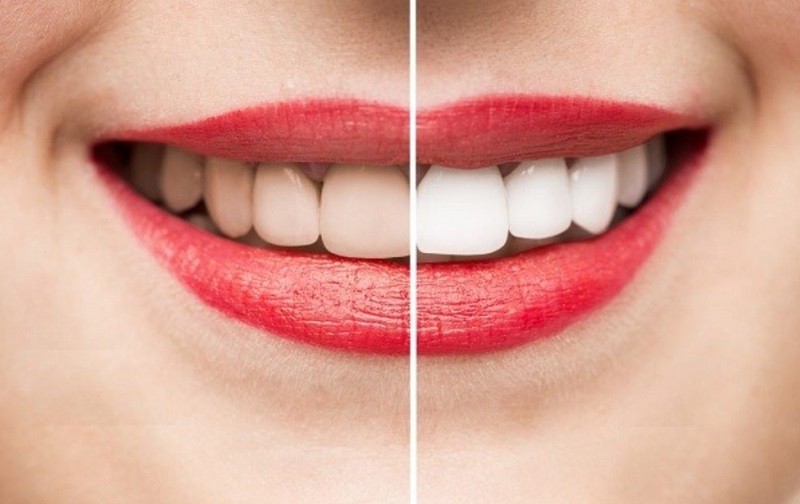 Tẩy trắng răng ở đâu tốt còn phụ thuộc vào nhiều yếu tố