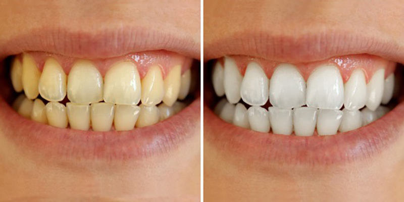 Bằng những công nghệ hiện đại, Nha khoa I-Dent sẽ giúp bạn có hàm răng trắng sáng hơn