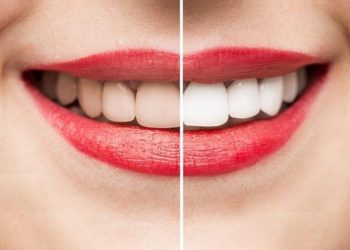 Tẩy trắng răng là gì? Các phương pháp phổ biến và quy trình thực hiện