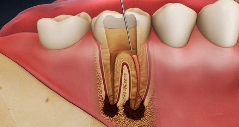 Tình trạng viêm tủy răng