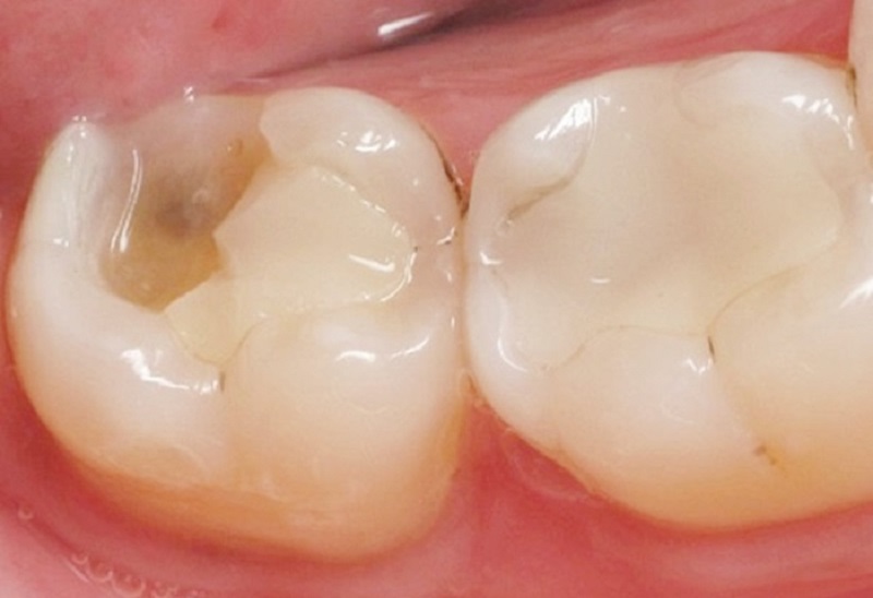 Chữa tủy răng bằng Hydroxit canxi là phương pháp khá phổ biến trong nha khoa