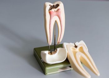 Vì Sao Phải Chữa Tủy Răng? Quy Trình Và Nguyên Tắc Chữa Tuỷ?