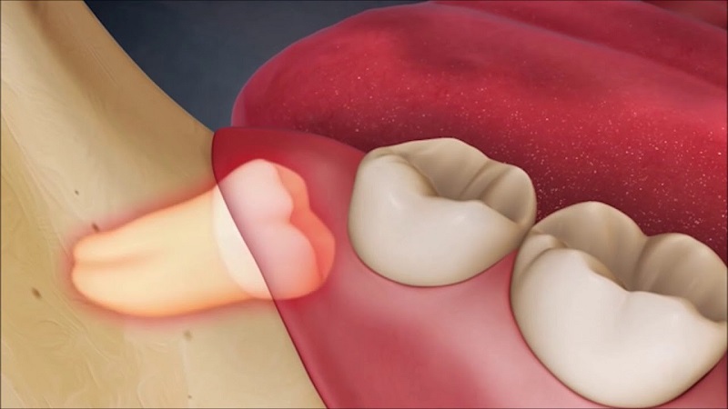 Loại bỏ răng số 8 để làm giảm ảnh hưởng xấu tới sức khỏe răng miệng
