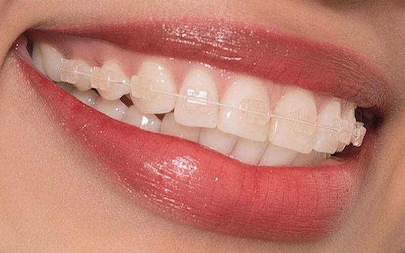 Niềng răng mắc cài sứ sẽ giúp tăng tính thẩm mỹ cho khuôn miệng