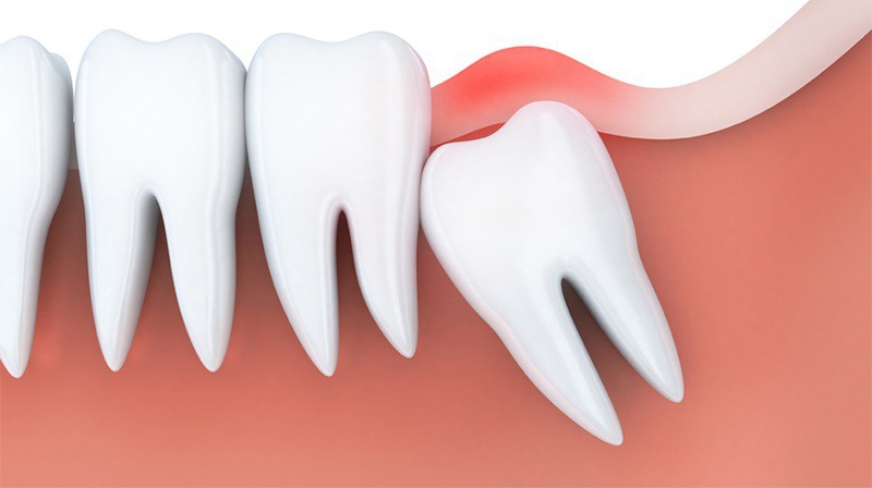 Răng khôn mọc lệch có thể gây ra tình trạng viêm lợi trùm