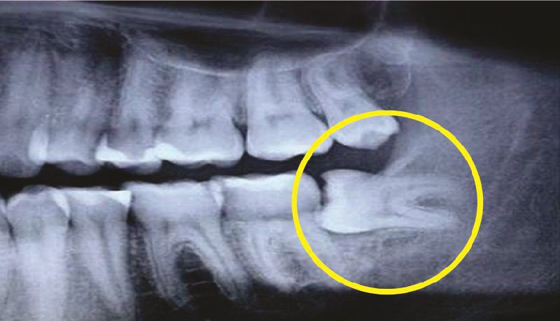 Chụp x-quang để xác định tư thế răng mọc lệch
