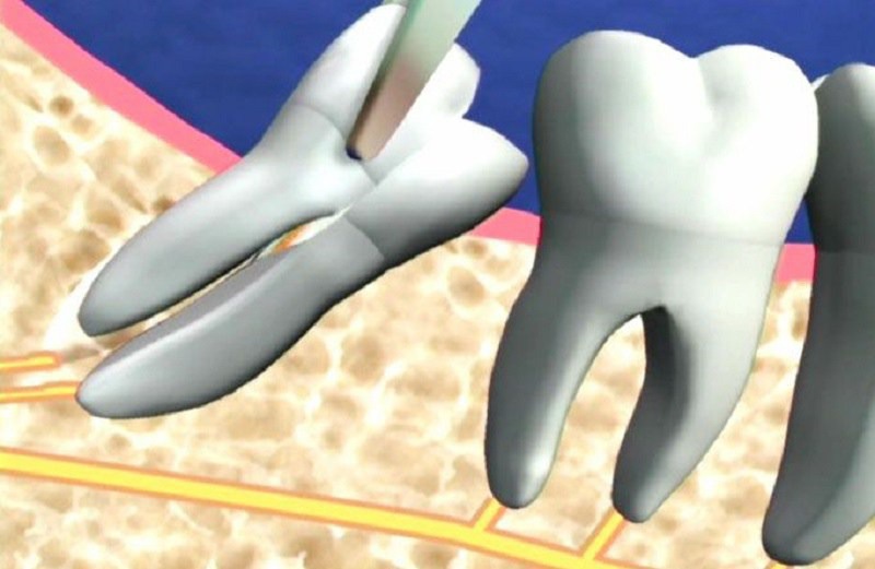 Để nhổ răng khôn mọc lệch dễ dàng, bác sĩ sẽ cắt đôi thân răng