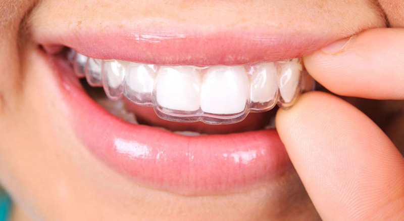 Quy trình niềng răng phải diễn ra đúng theo các bước quy định