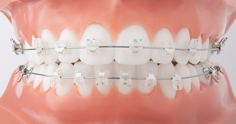 Kỹ thuật niềng răng mắc cài sứ được nhiều người áp dụng