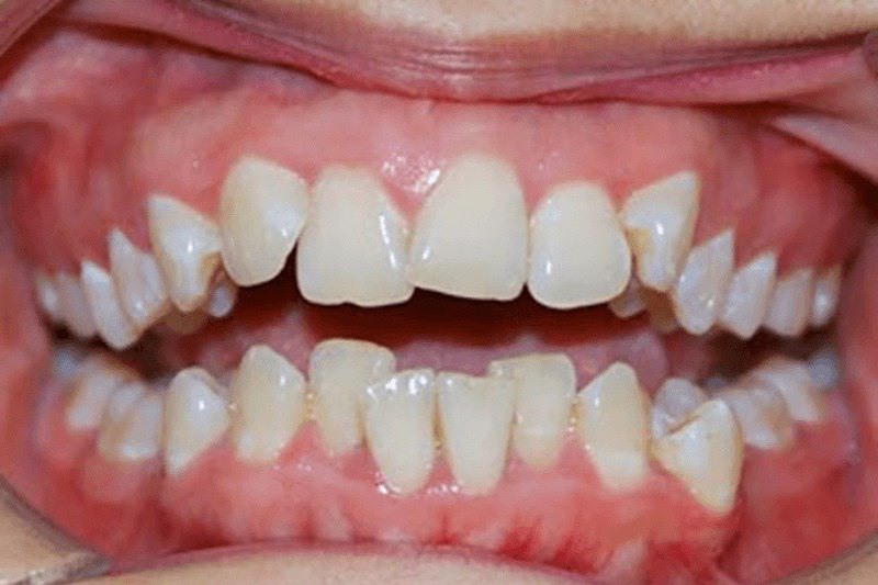 Răng bị lệch lạc quá nhiều thì hàm Trainer không mang lại tác dụng