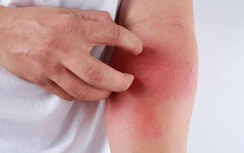 Phát ban và nổi mẩn đỏ trên da là một trong các tác dụng phụ có thể xảy ra