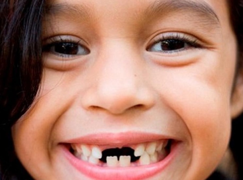 Thậm chí, bệnh lý này có thể làm ảnh hưởng tới quá trình mọc răng của bé