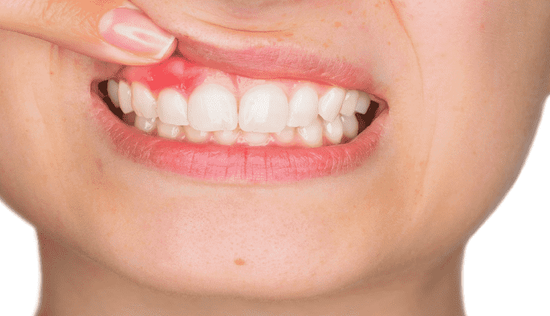 Điều trị áp xe răng khi còn nhẹ tương đối dễ dàng và nhanh lành