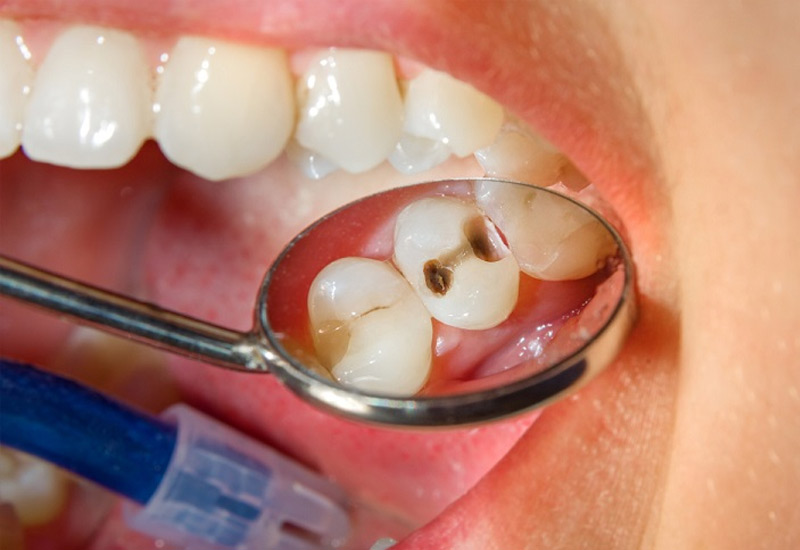 Việc điều trị nội nha không đảm bảo rất dễ dẫn đến ê buốt răng sau khi trám