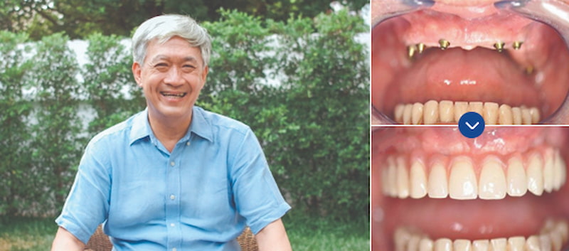 Hình ảnh bác Đan thay đổi nhan sắc trước và sau khi trồng răng